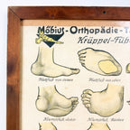 Set van 2 vintage Duitse anatomische orthopedische voetposters