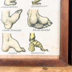 Set van 2 vintage Duitse anatomische orthopedische voetposters